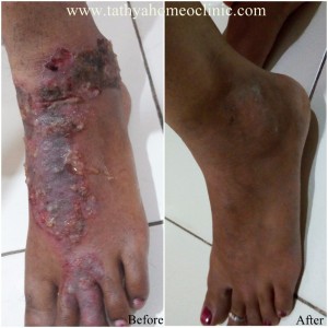 Case of Psoriasis with suppuration